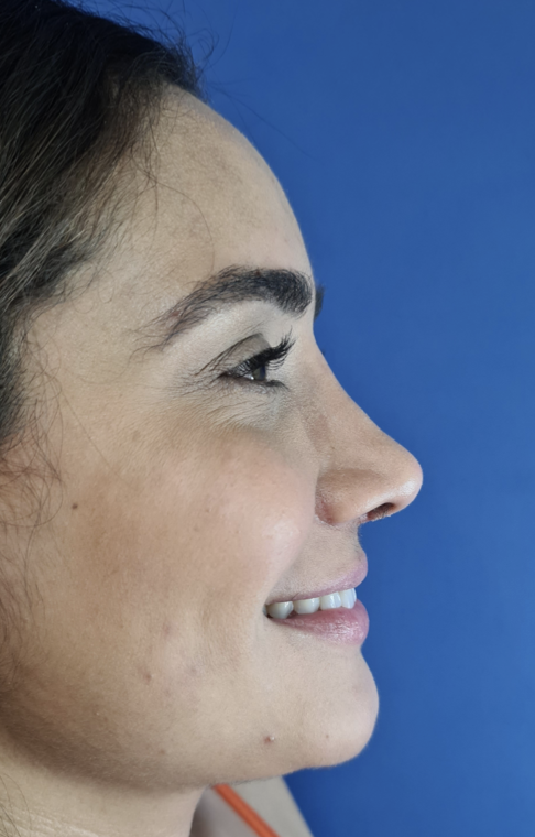 Depois da rinoplastia