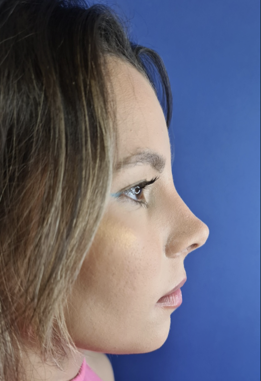 Depois da rinoplastia